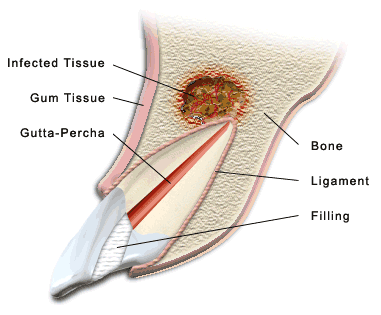 Animated diagram of the apicoectomy process