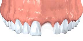 Digital illustration of an avulsed tooth