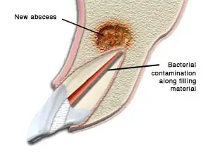 A diagram of an improperly healed root canal due to bacterial contamination along the filling material