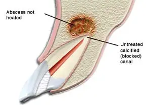 A diagram of an improperly healed root canal due to an untreated calcified canal