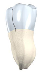 3D model of a tooth of a cracked tooth