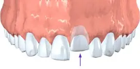 Digital illustration of a tooth pushed back into its socket