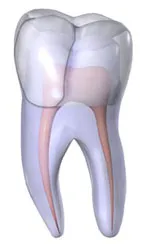 3D model of a tooth with a fractured cusp