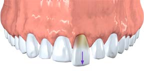 Digital illustration of a tooth pushed partially out of its socket