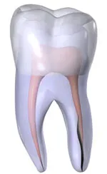 3D model of a tooth with a vertical root fracture