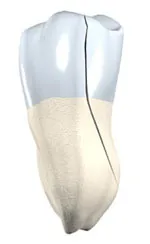 3D model of a tooth of a split tooth