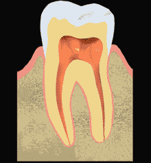 Animated diagram of the different stages of a root canal